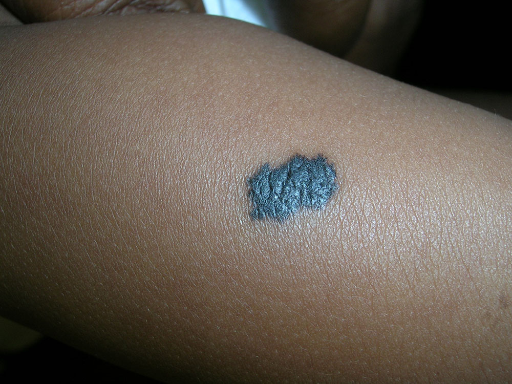 nevus, congenital