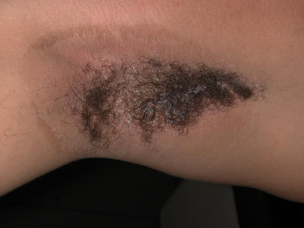 contact dermatitis, irritant