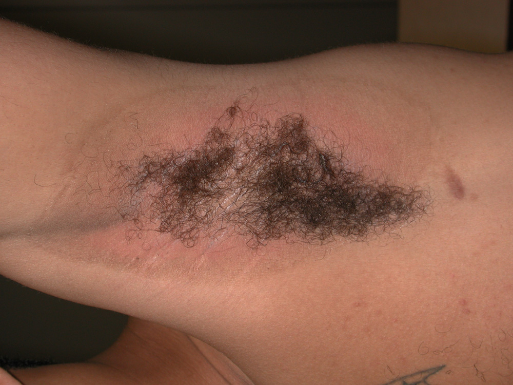 contact dermatitis, irritant