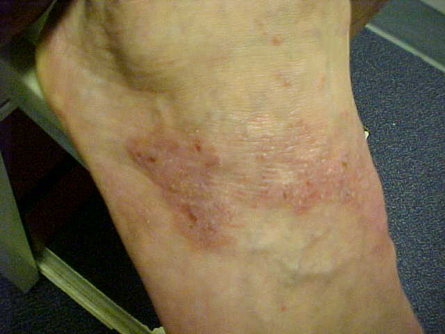 contact dermatitis, irritant