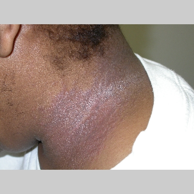 contact dermatitis, irritant