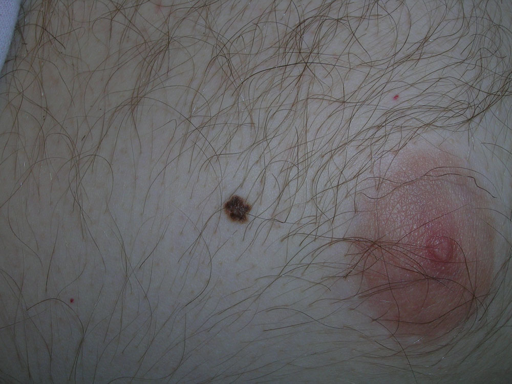 nevus, dysplastic