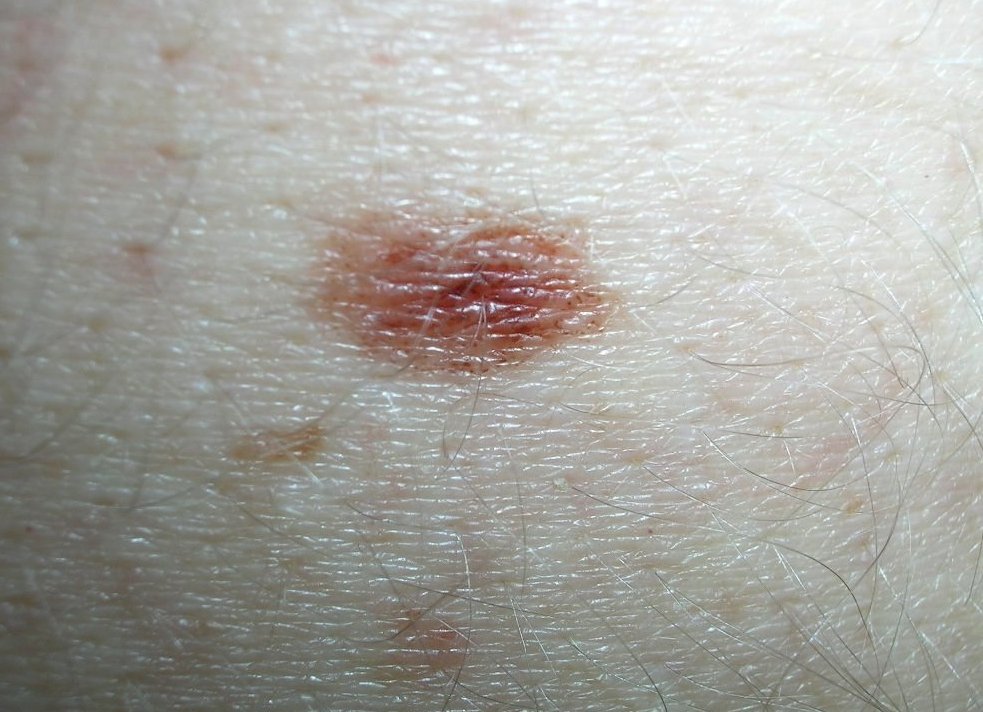 nevus, dysplastic