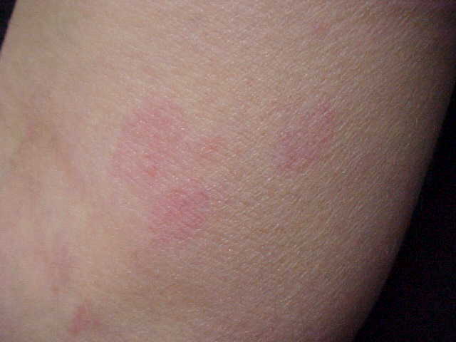 erythema annulare centrifugum