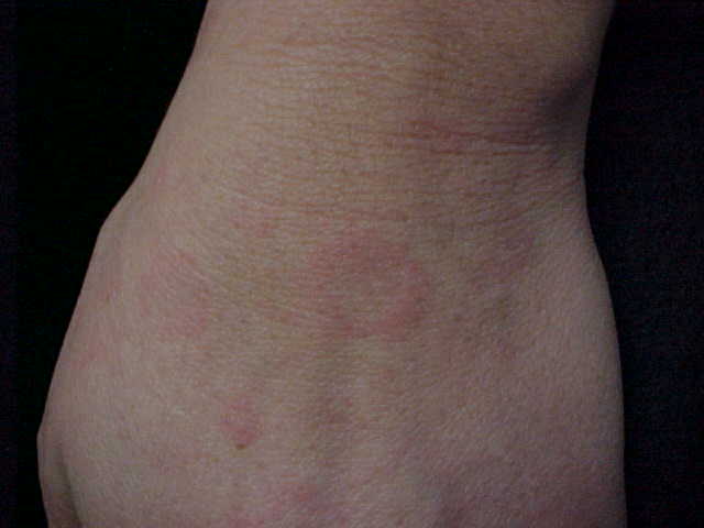 erythema annulare centrifugum