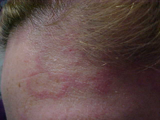 erythema annulare centrifugum