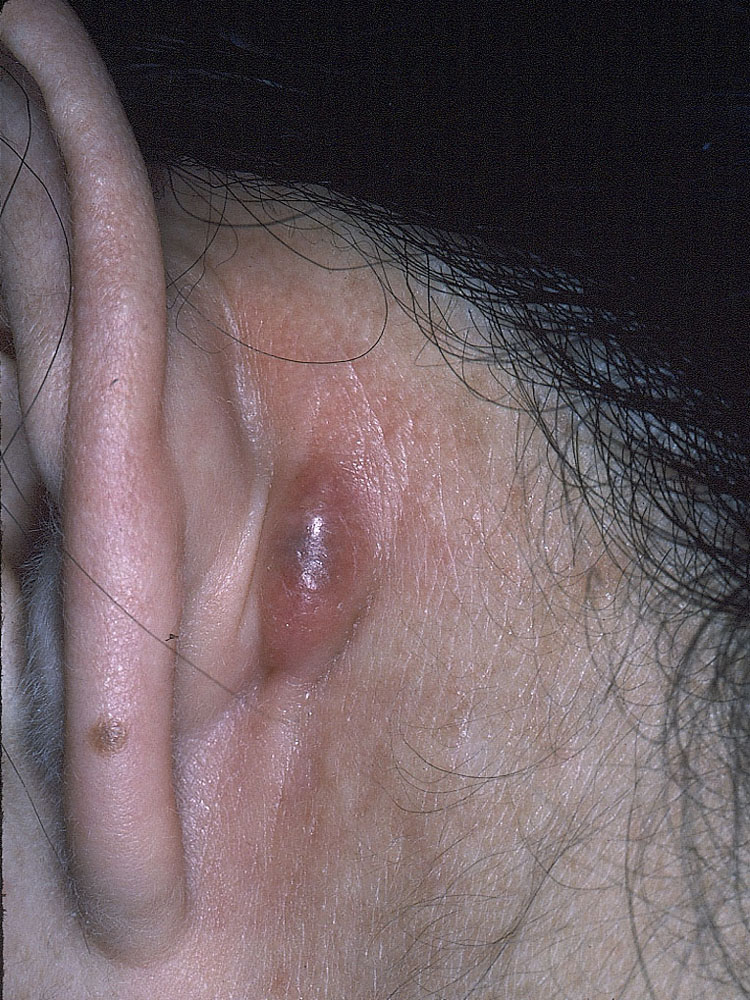 cyst, epidermal