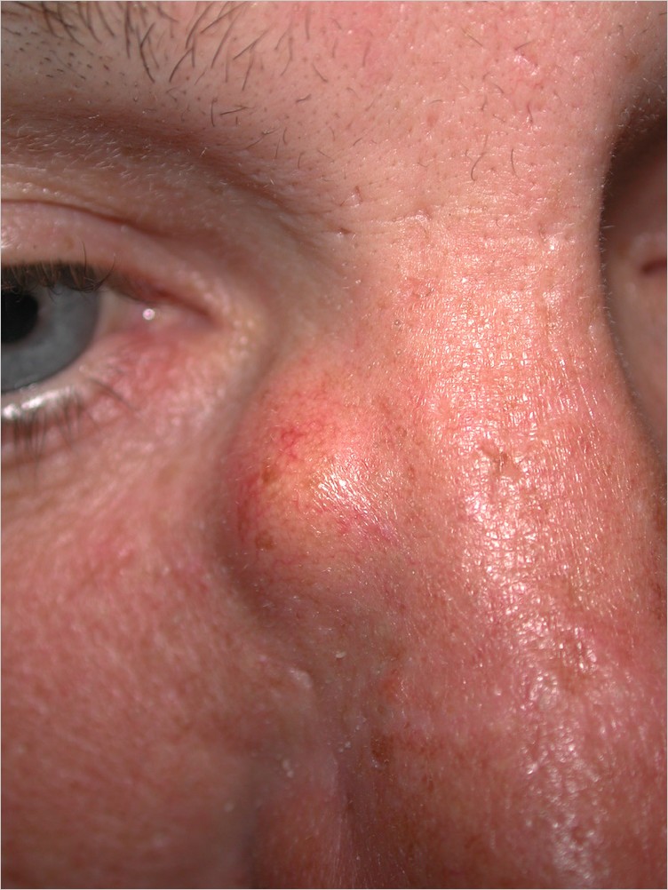 cyst, epidermal