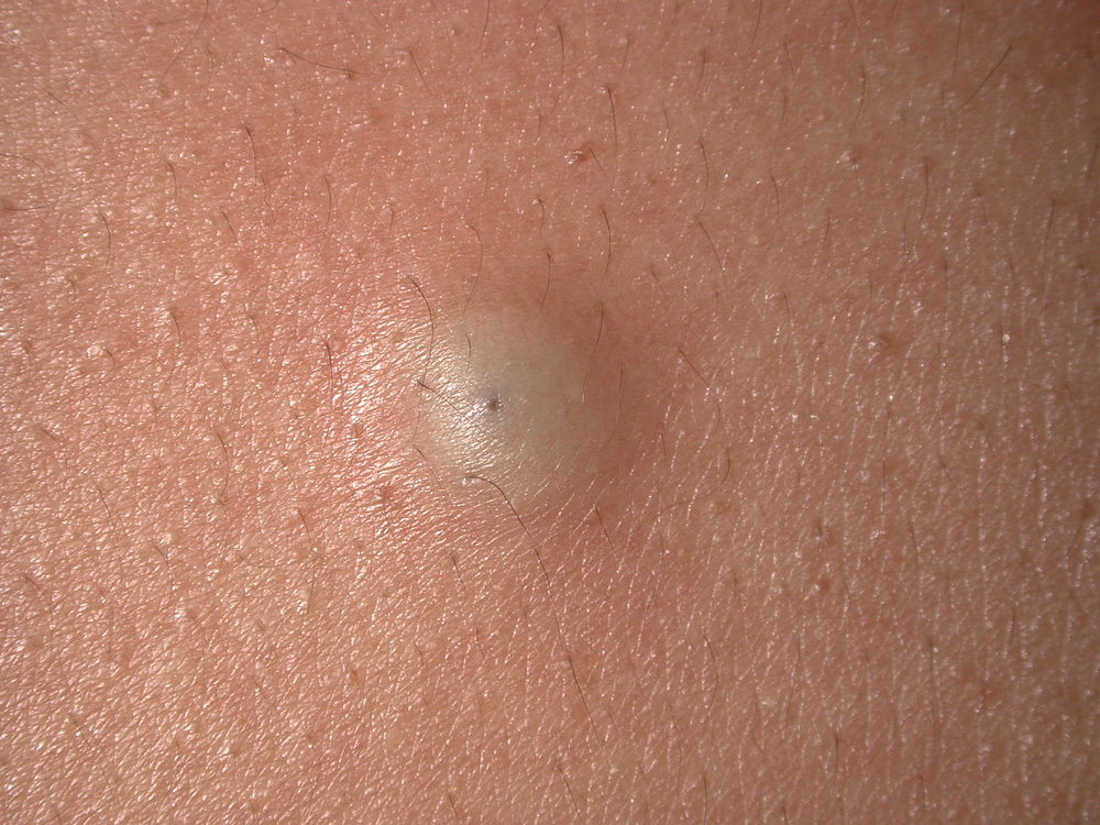 cyst, epidermal