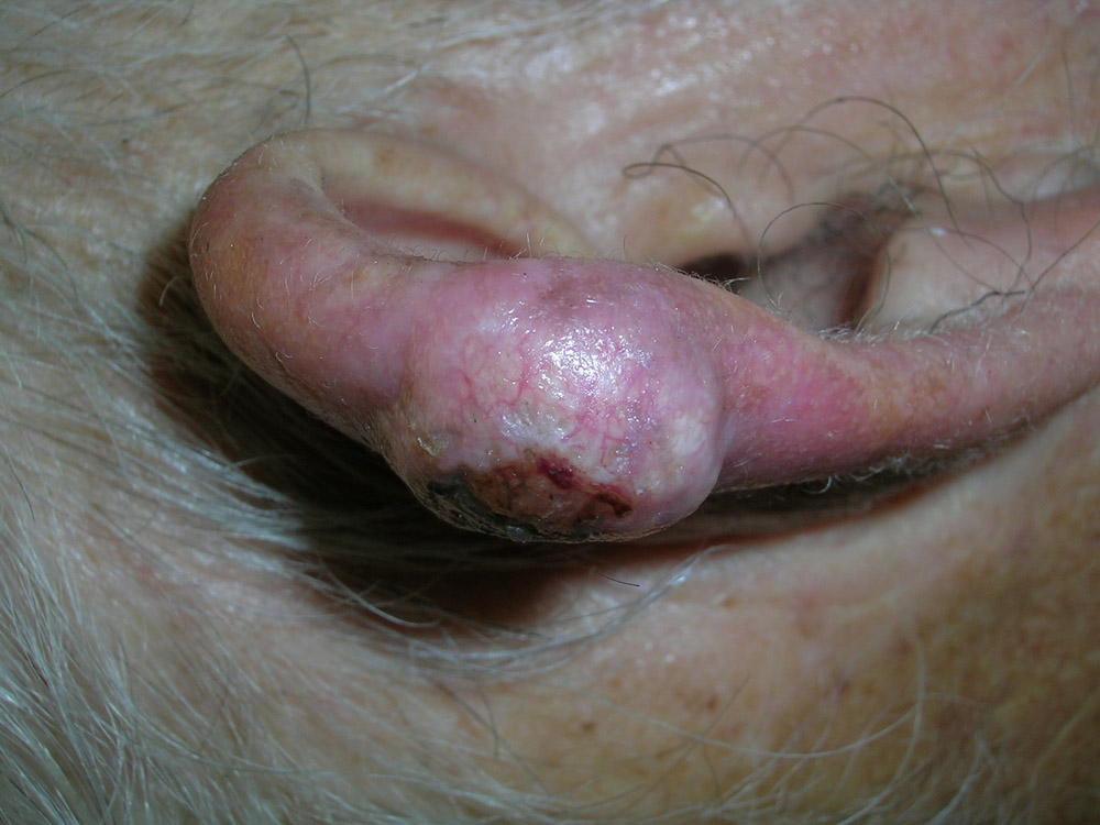 keratoacanthoma