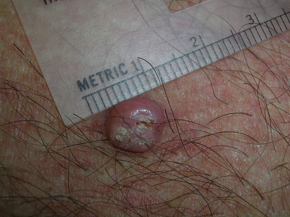 keratoacanthoma