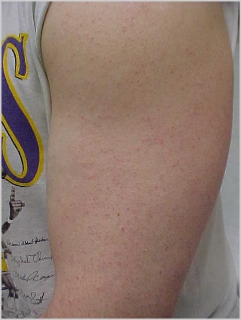 keratosis pilaris