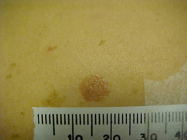 nevus, congenital