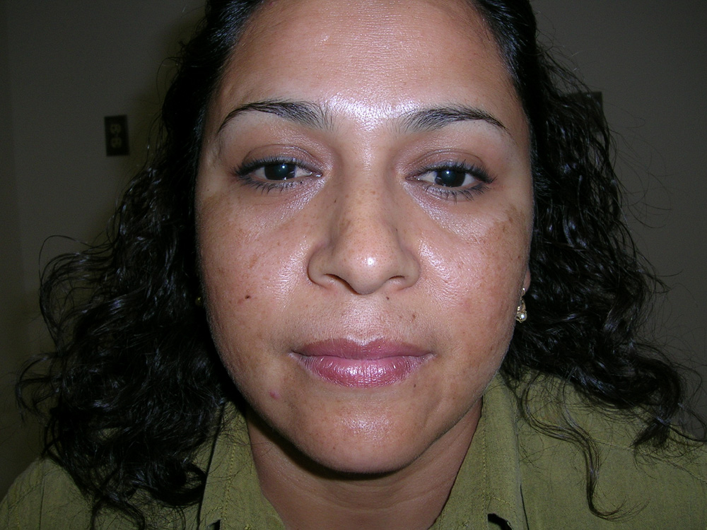 melasma