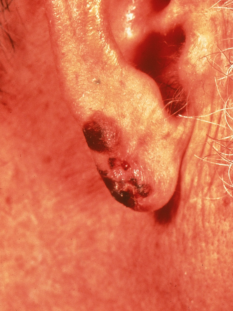 melanoma, superficial spreading