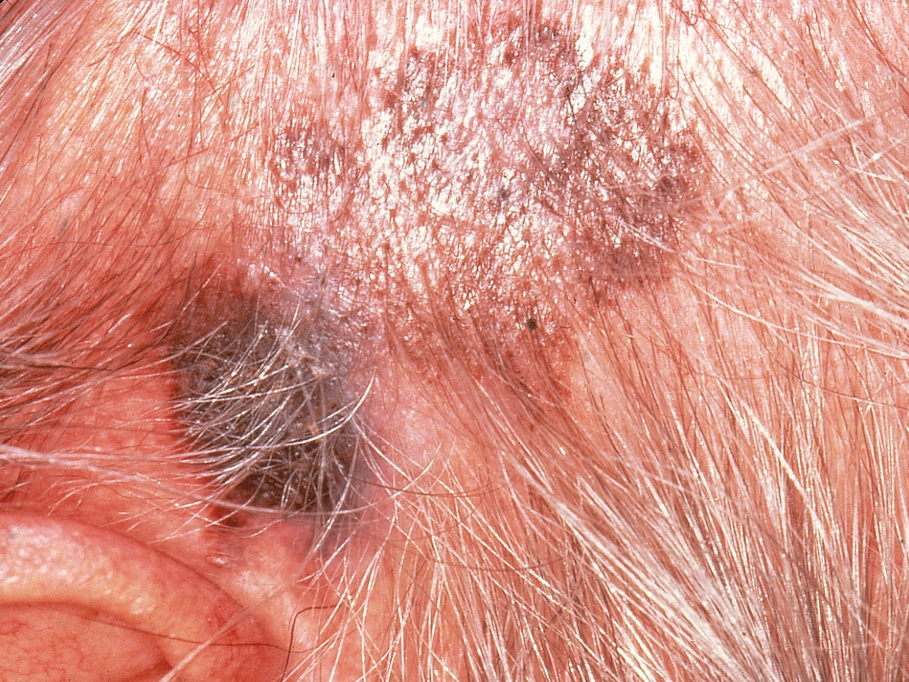 melanoma, superficial spreading