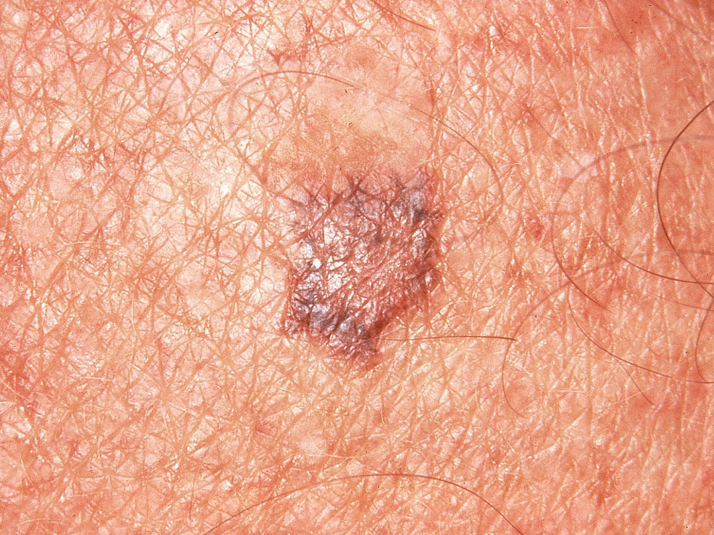 melanoma, superficial spreading