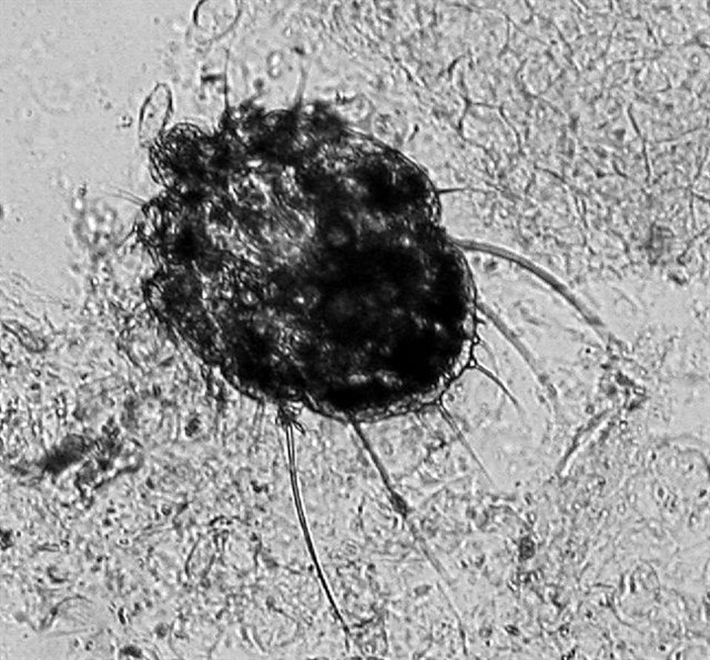 Scabies Micro Video scabies
