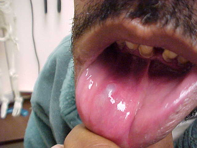mucocele