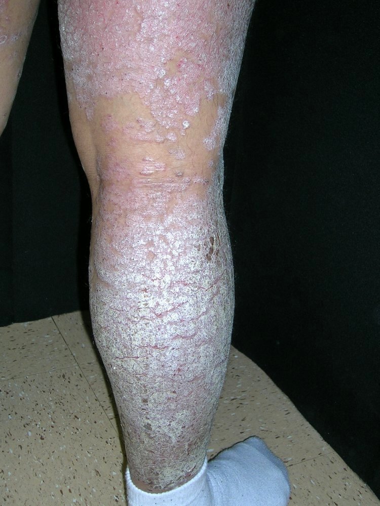 psoriasis
