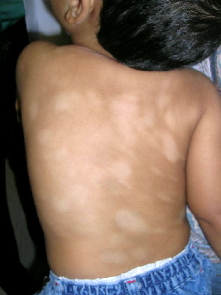 pityriasis alba