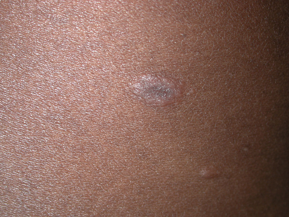 pityriasis rosea