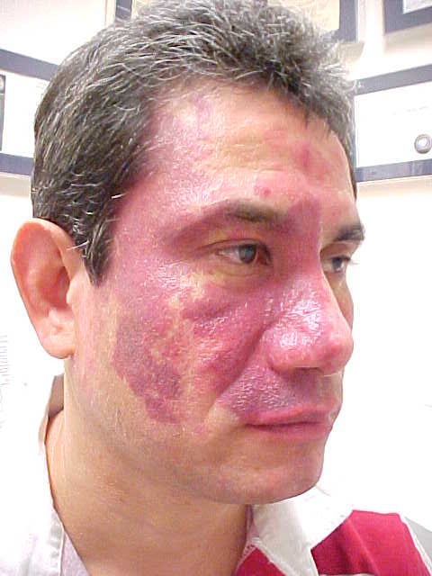 hemangioma, strawberry