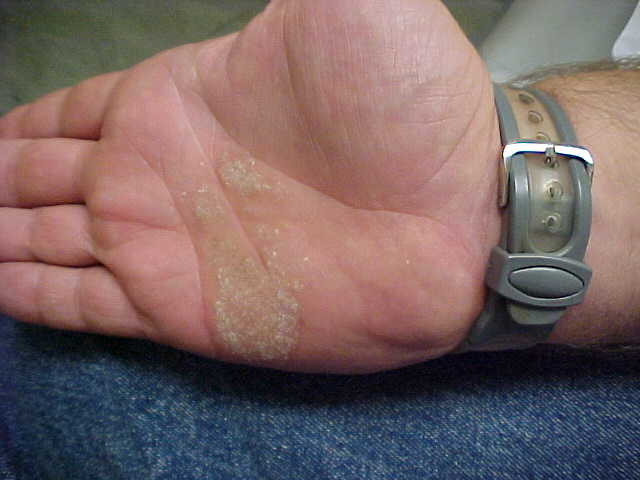 psoriasis