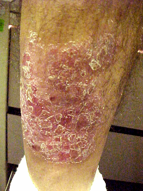 psoriasis