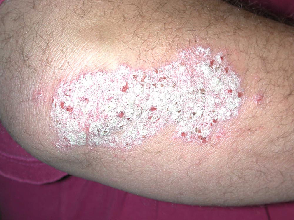 psoriasis