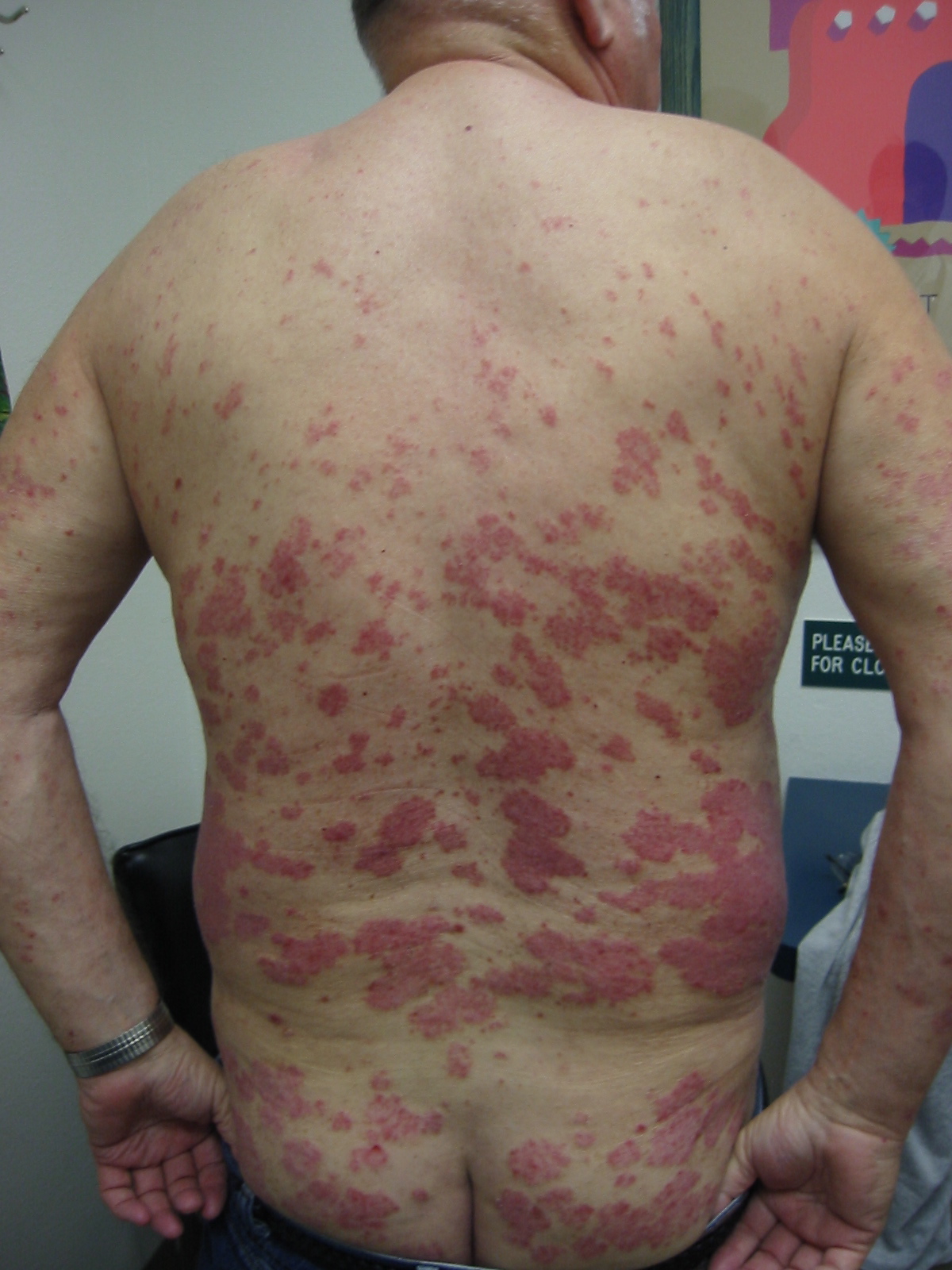 psoriasis