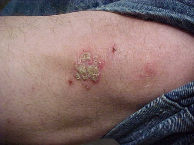 psoriasis