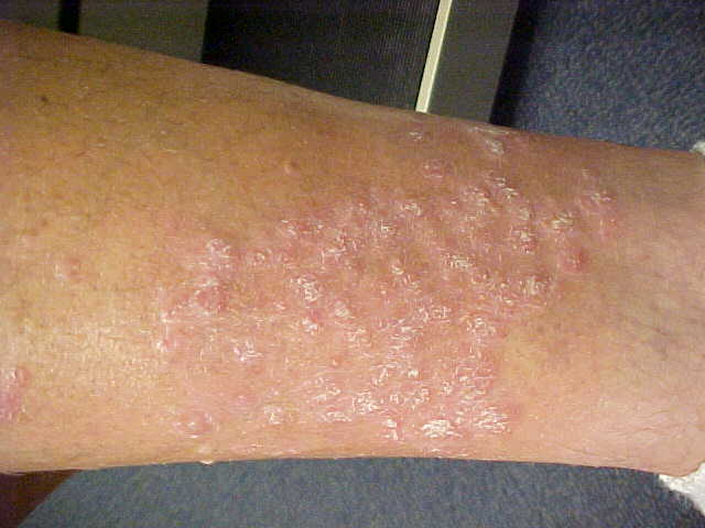psoriasis