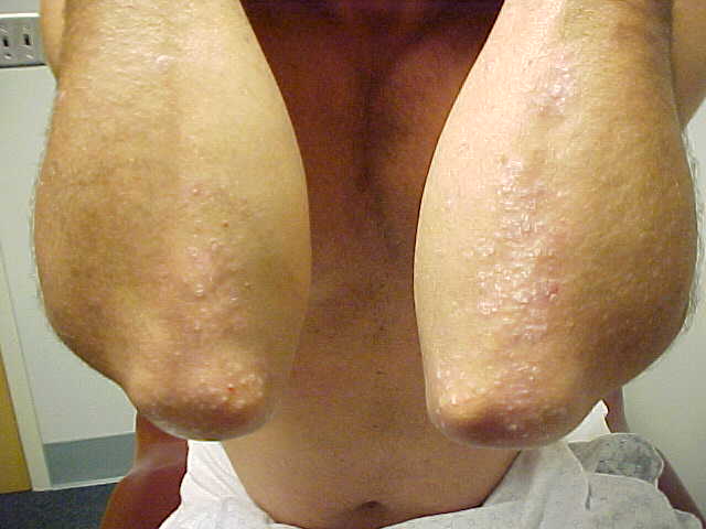 psoriasis