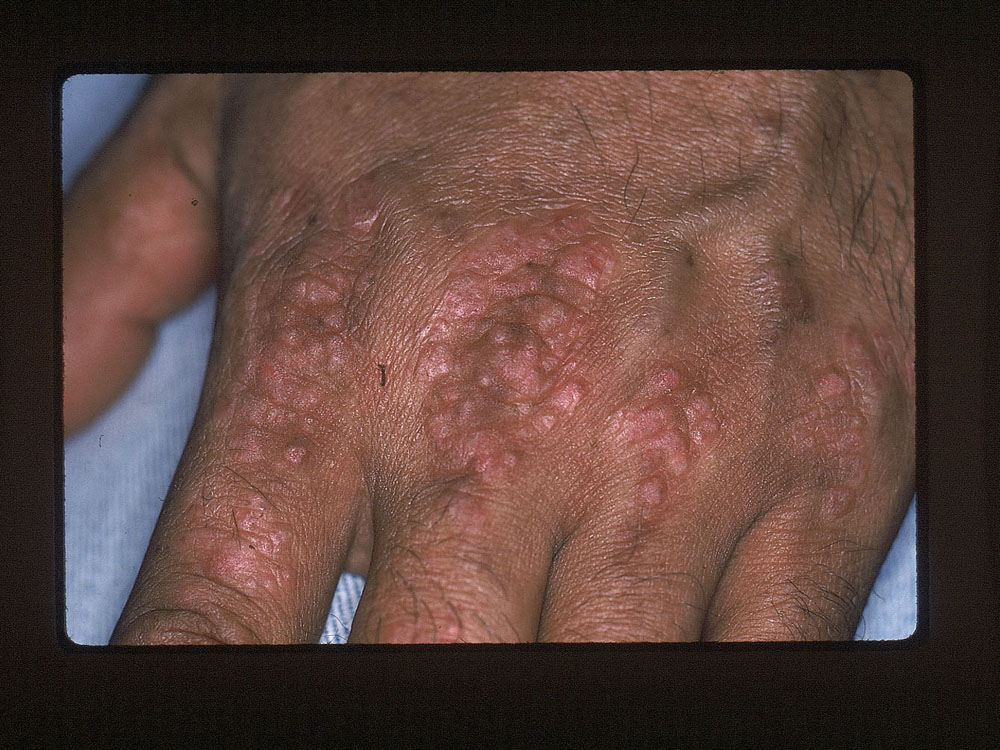 psoriasis