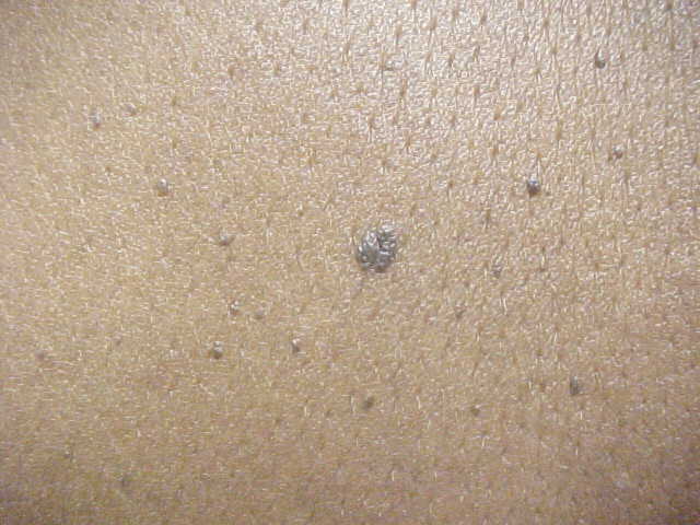 seborrheic keratosis