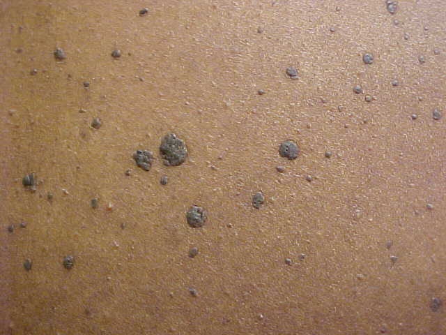 seborrheic keratosis