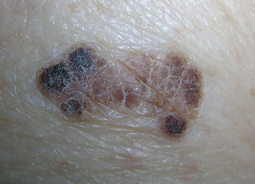 seborrheic keratosis