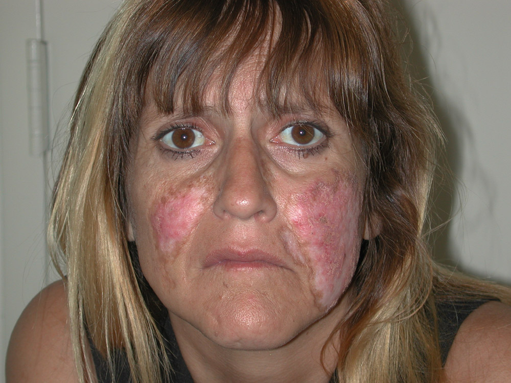 lupus erythematosus, systemic