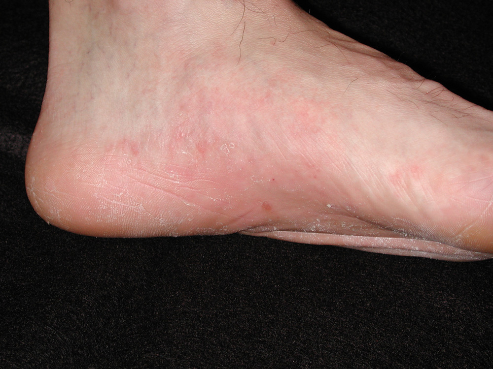 tinea pedis