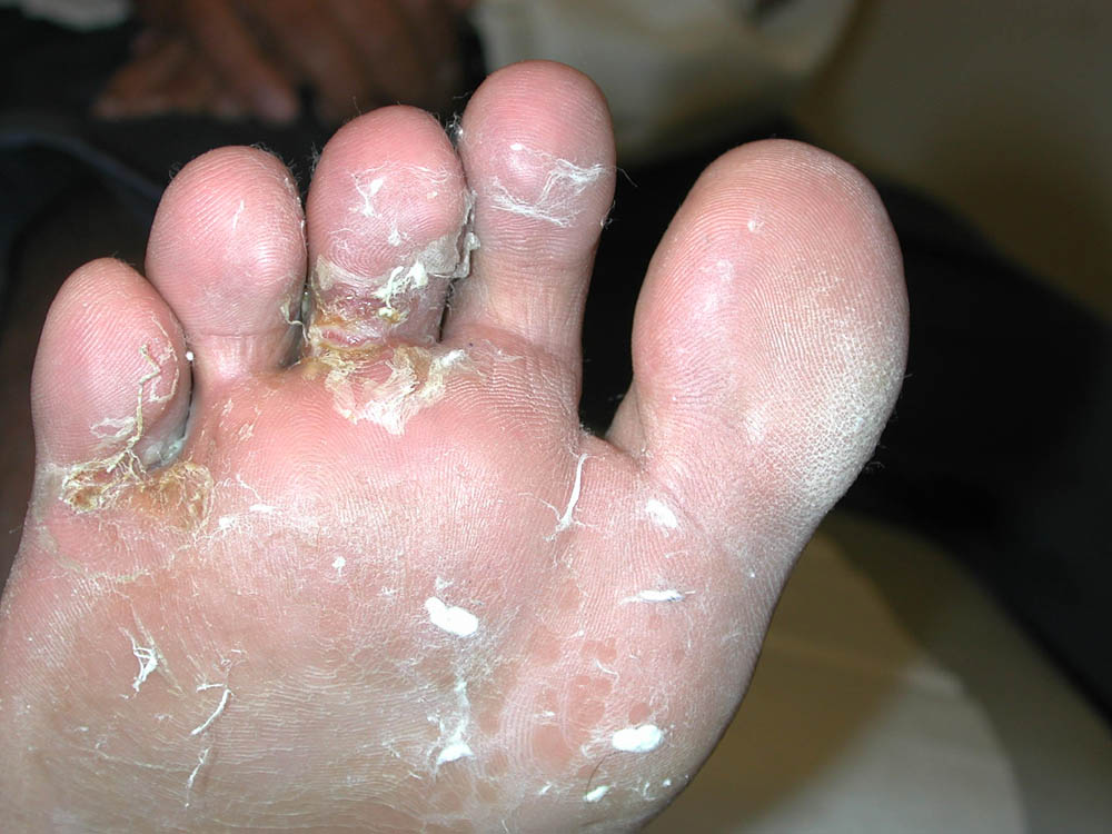 tinea pedis
