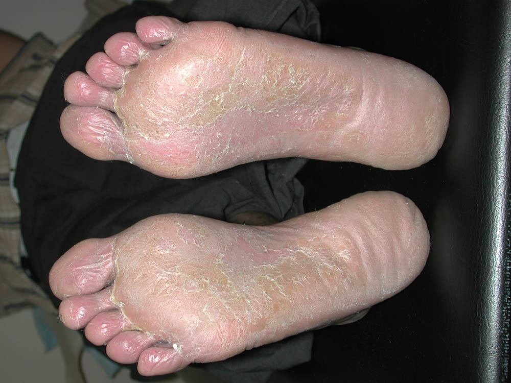 tinea pedis