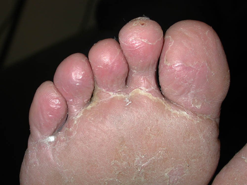 tinea pedis