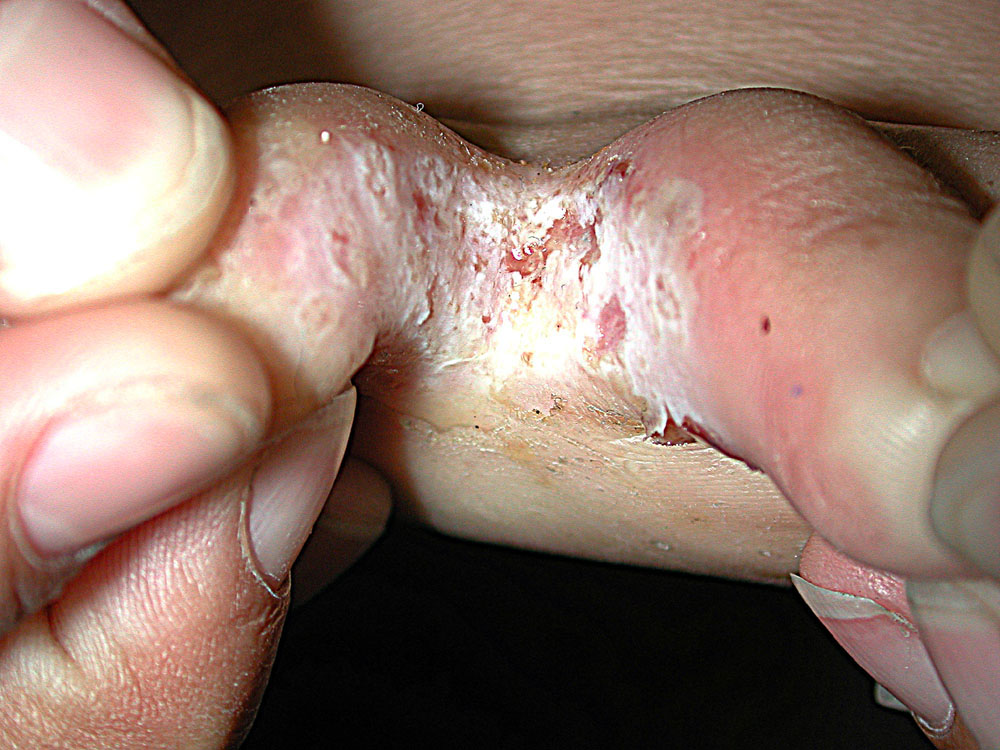 tinea pedis