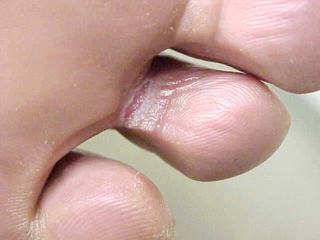 tinea pedis