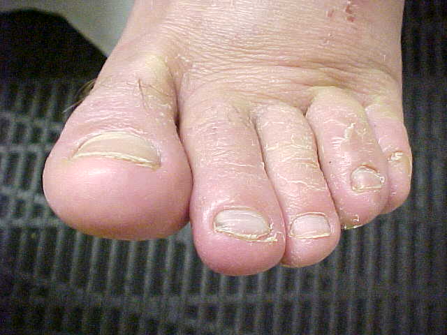 tinea pedis
